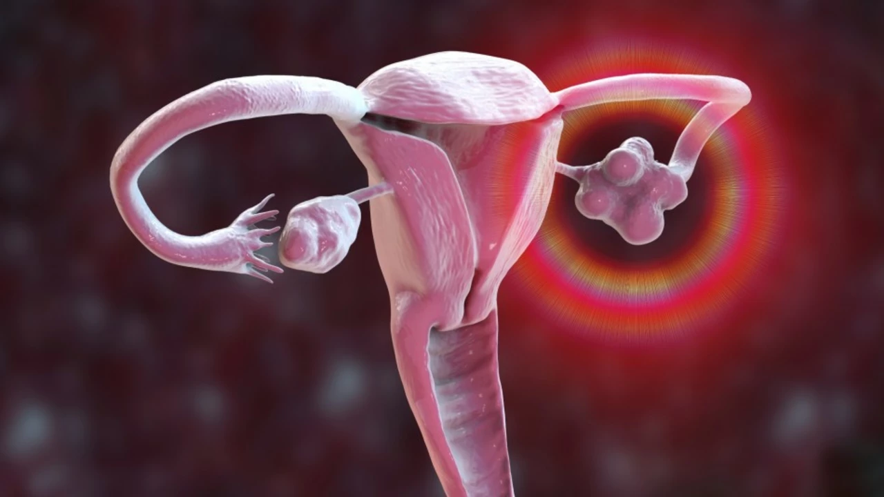 El papel de la Ezetimiba en el manejo del Síndrome de Ovario Poliquístico (SOP)